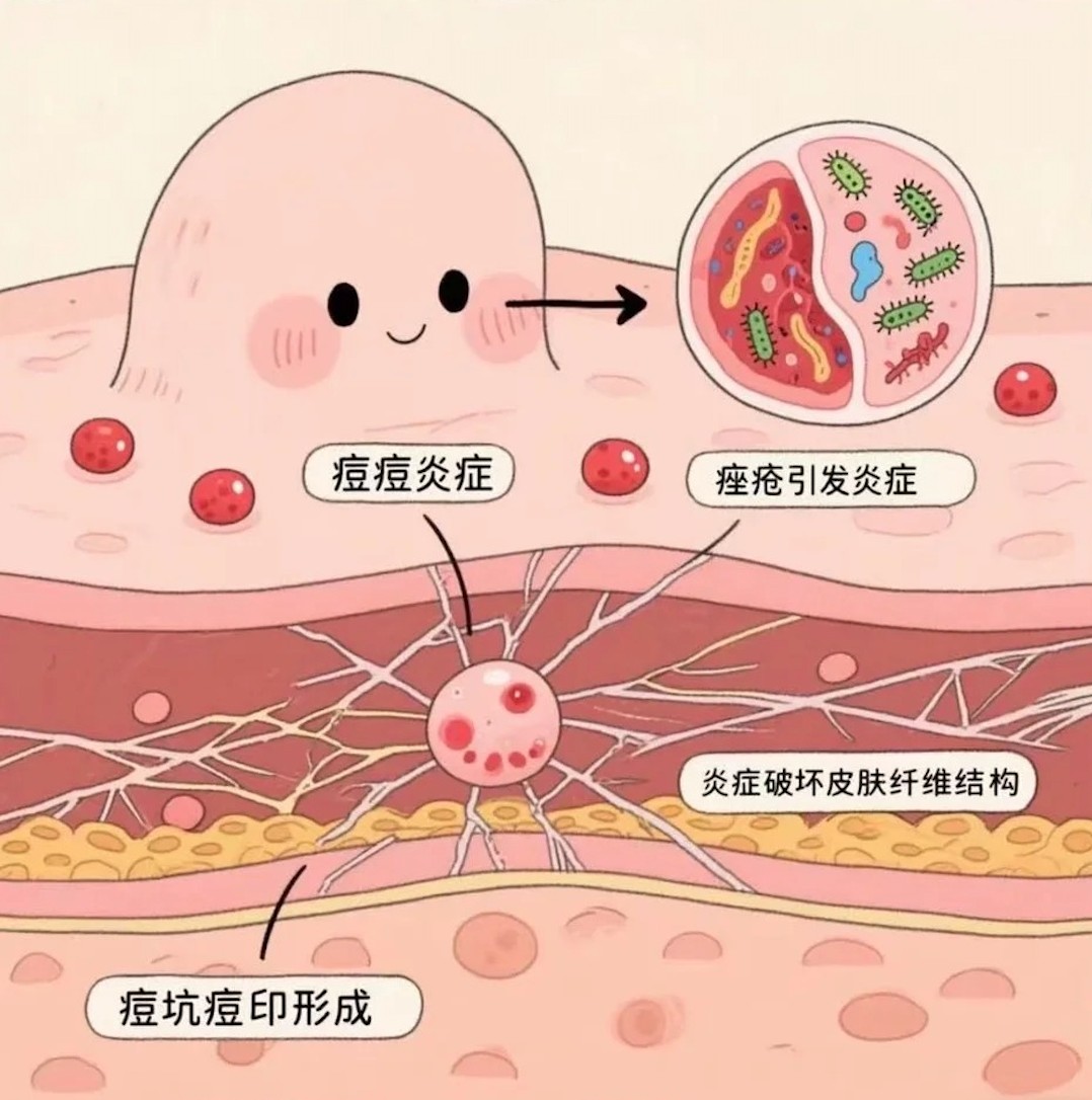 祛痘化妆品功效原理和功效评价